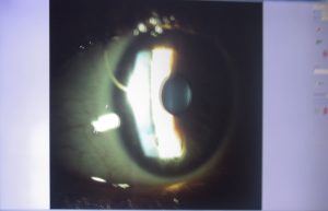 Screening of a student's eye